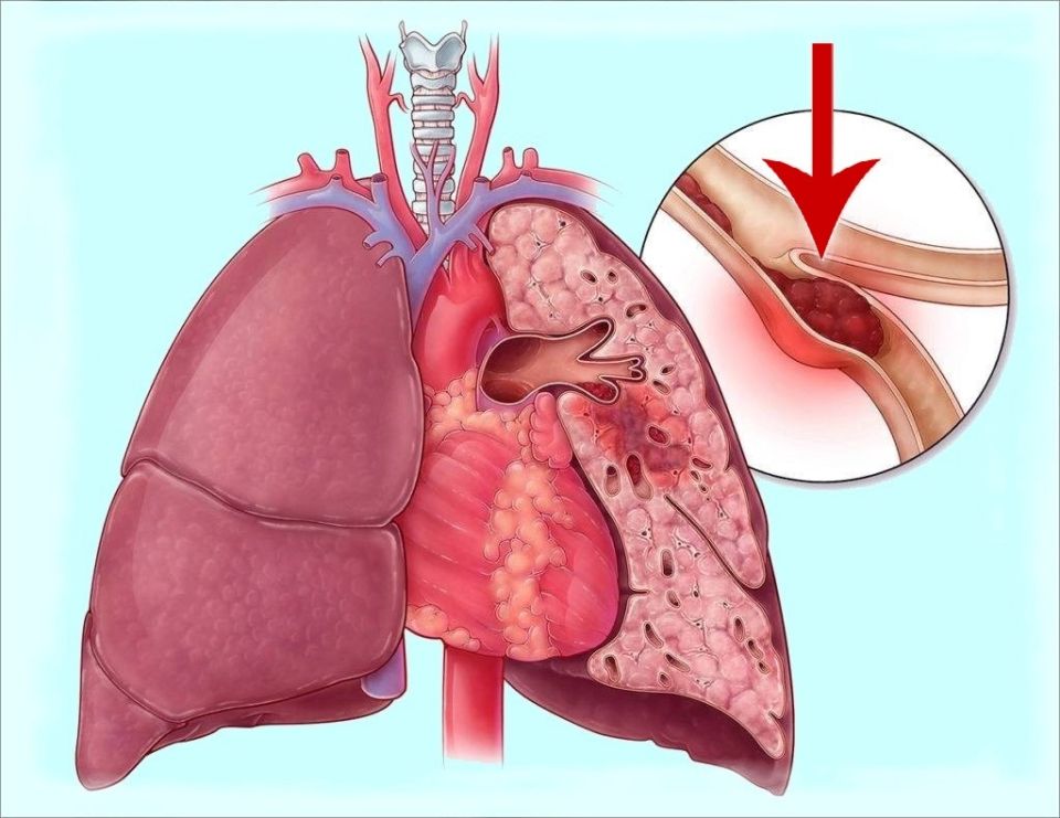 Тайна смертности во сне: как тромбы становятся врагами здоровья